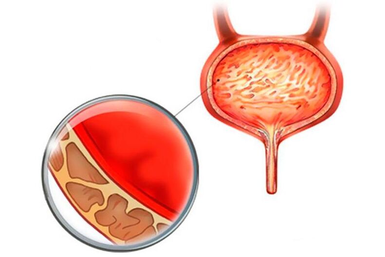 Inflammation de la membrane muqueuse de la vessie avec cystite